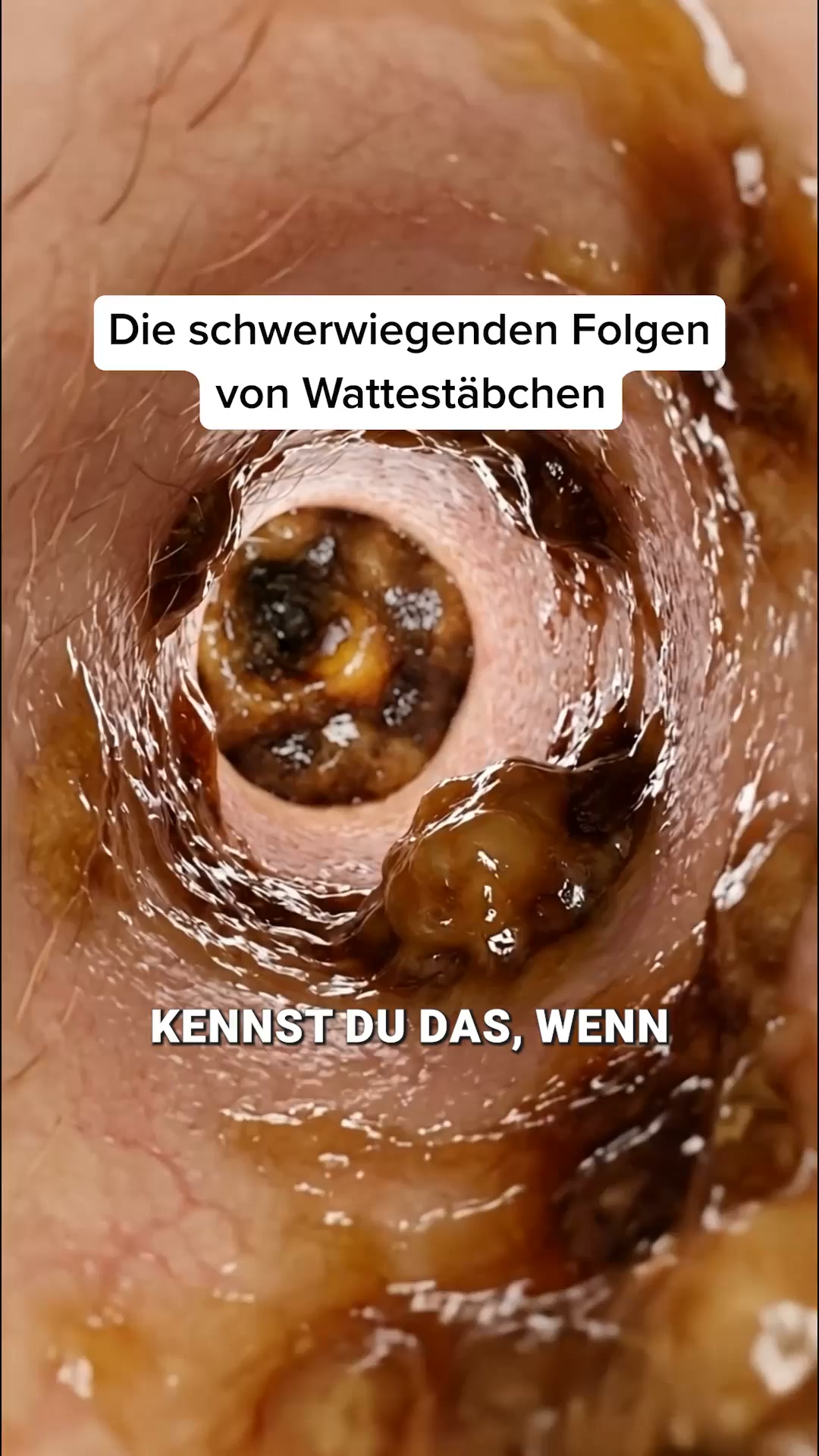 Endlich saubere & freie Ohren