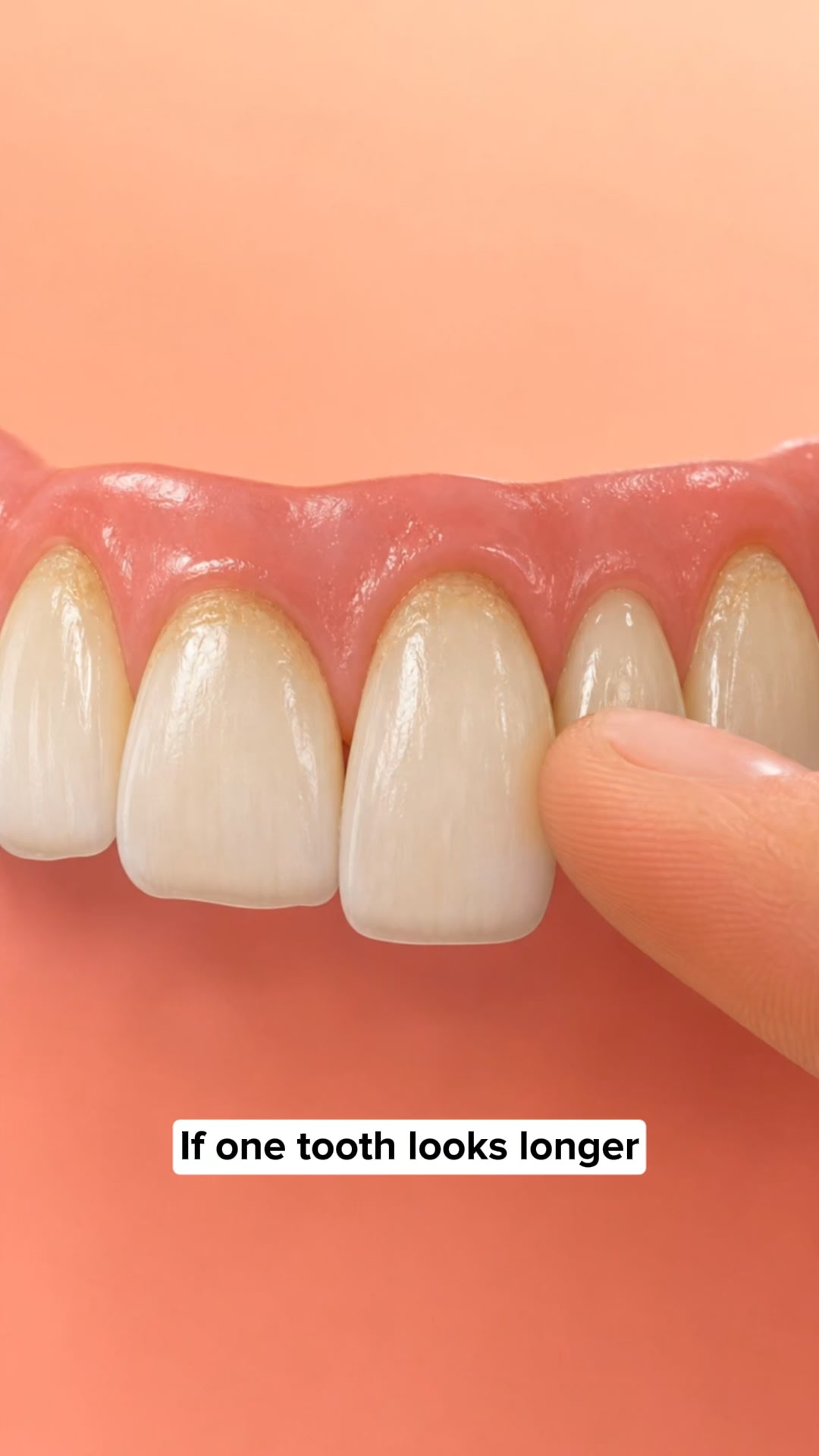 My Gums Kept Pulling Back