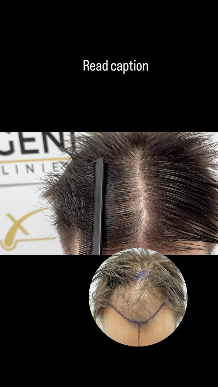 Anúncio de FueGenix Haarkliniek