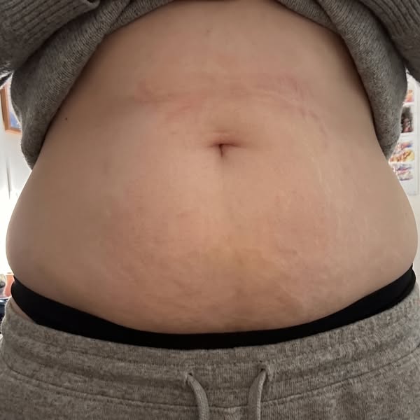 Dein Cortisol sinkt nicht, bis deine Leber wieder mitkommt