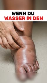 Schwellungen natürlich lindern