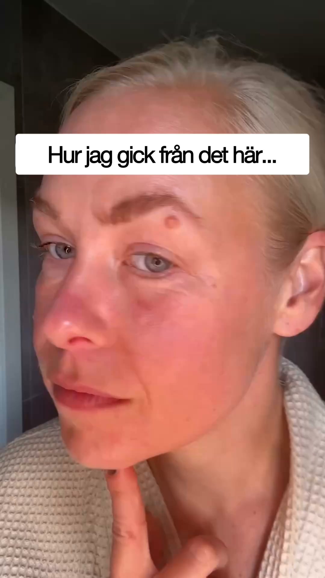 Slätare linjer utan botox