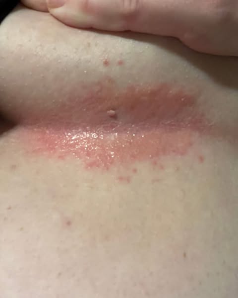 Skin Fold Rash? Red This Before It gets Worse!