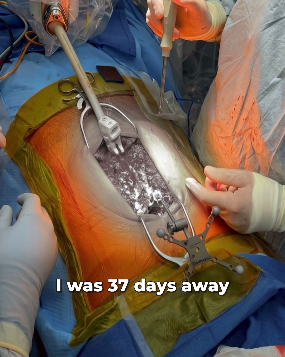 Read This Before Your Sciatica Surgery