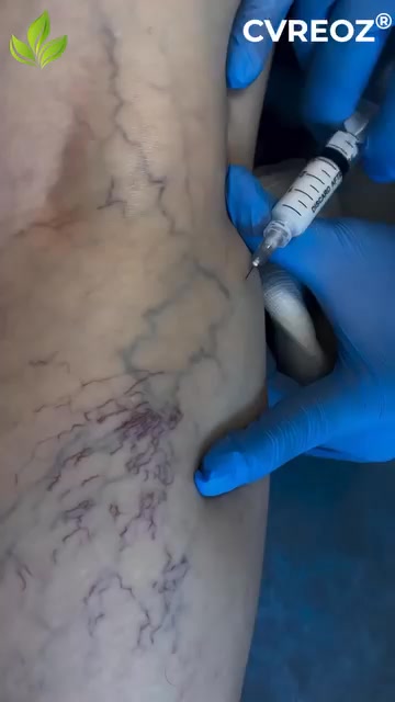 Shrink Varicose Veins Without Surgery