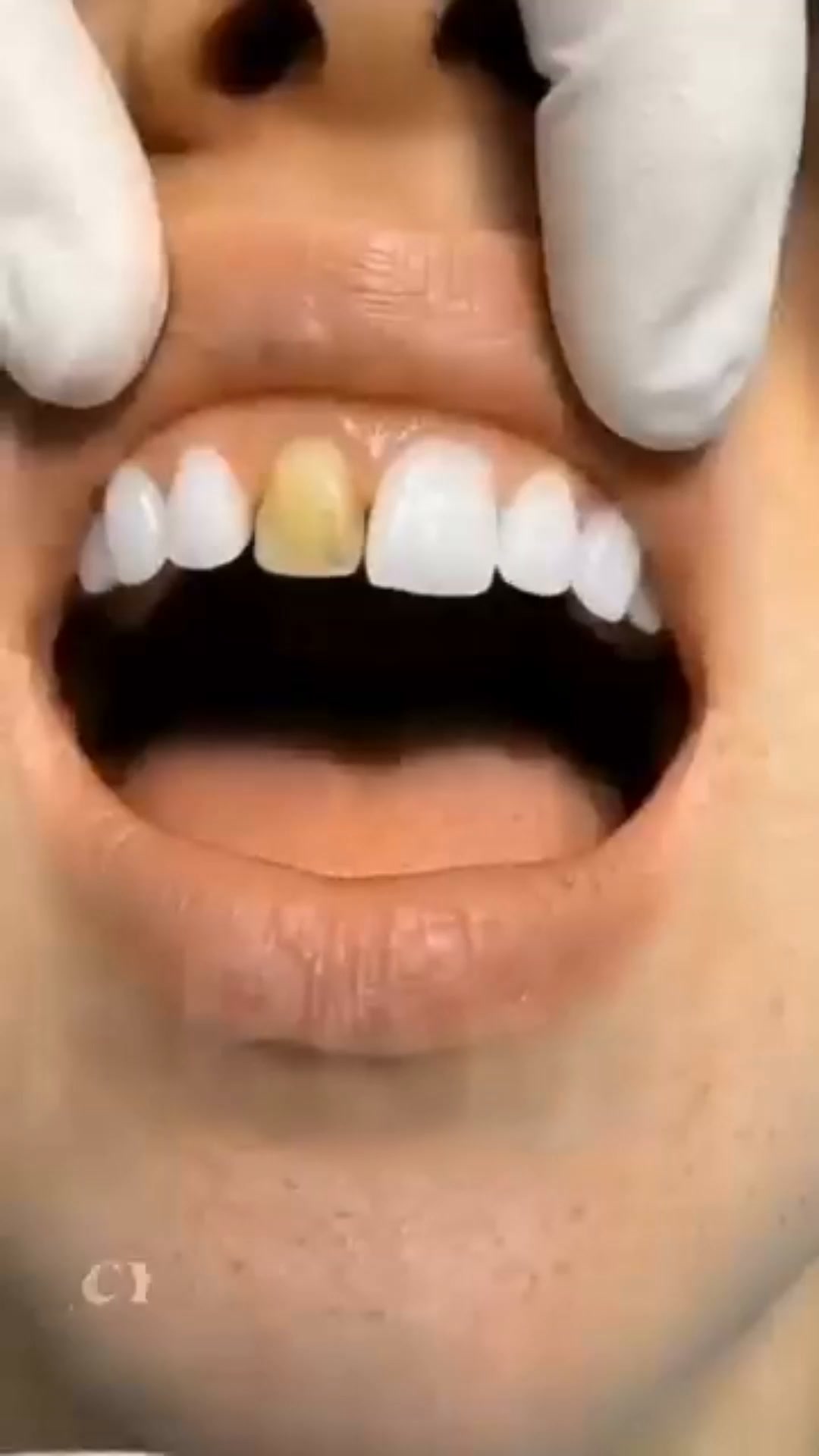 Restore Your Smile With Natural Enamel Repair Technology