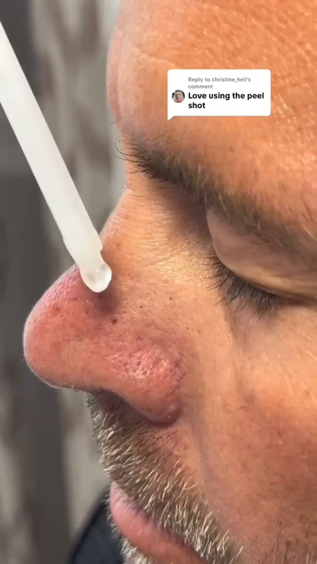 Say goodbye to blackheads