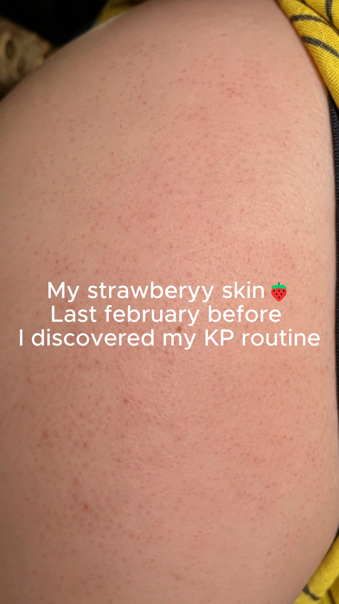 Why Do KP Bumps Keep Coming Back?