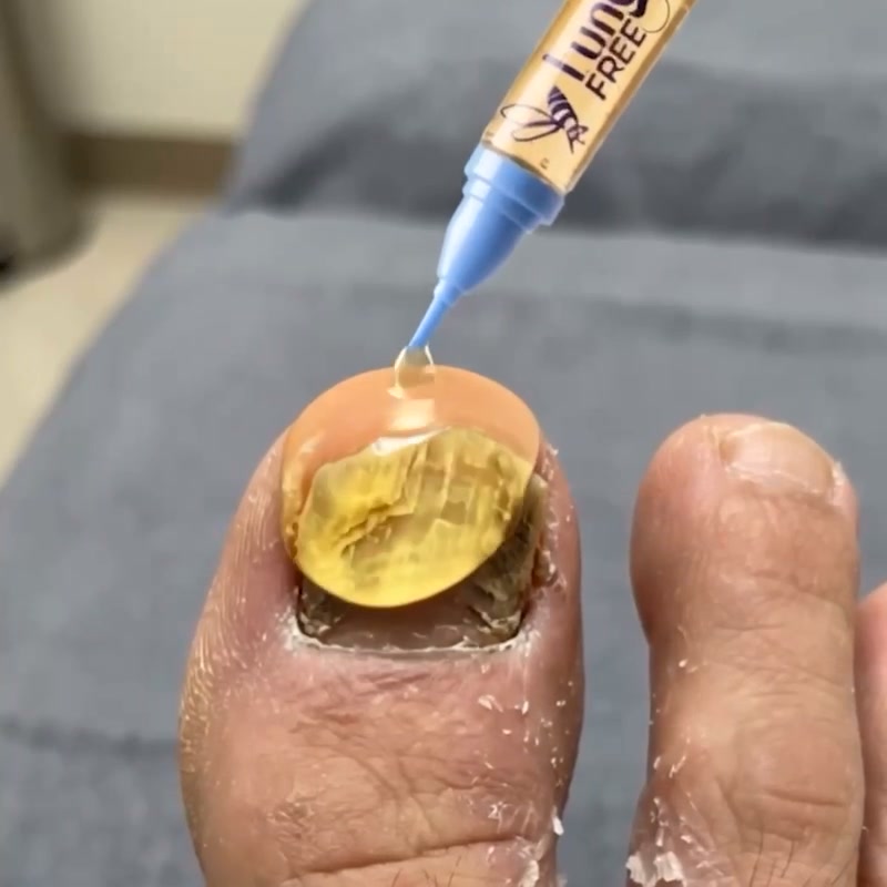 Tiefenwirksame Nagelpilz-Pflege | Laborgeprüft & Sicher