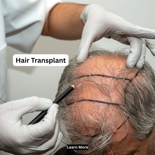 Hair Transplant