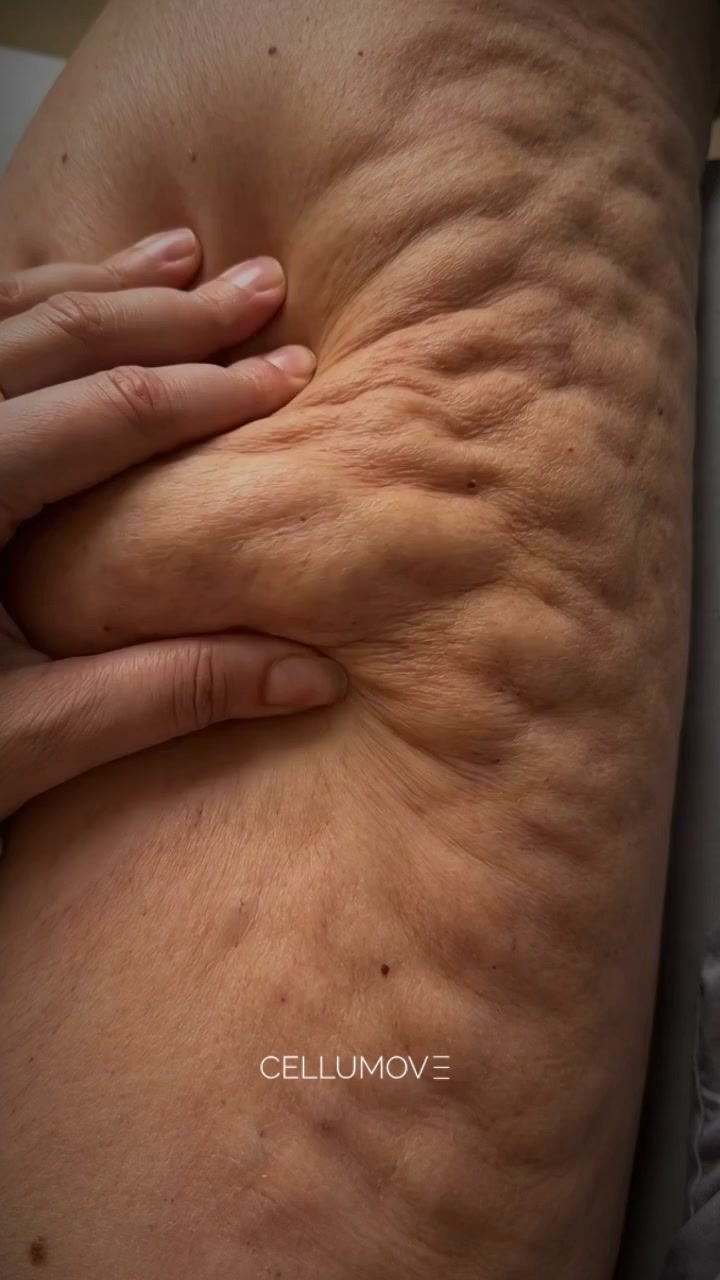 ¡Empieza hoy mismo a aliviar los síntomas del lipedema!