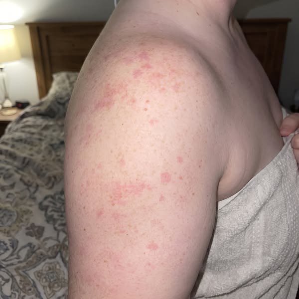 what 2 doctors missed about my dry itchy skin