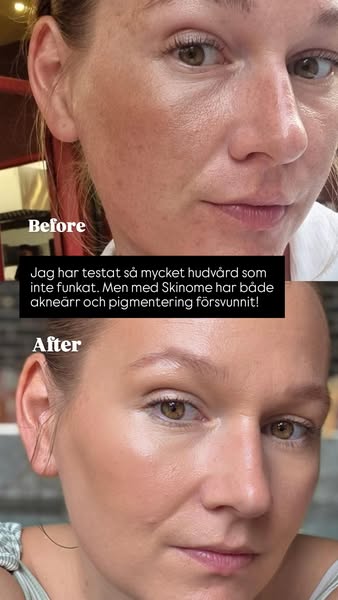 Vetenskapen bakom klarare hud