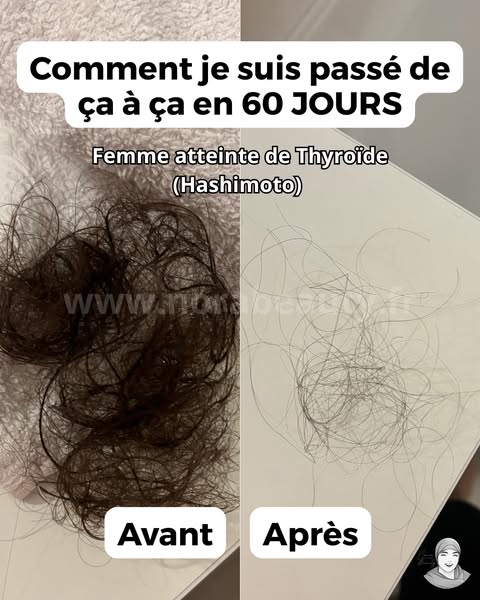 Thyroïde & chute de cheveux : une solution douce