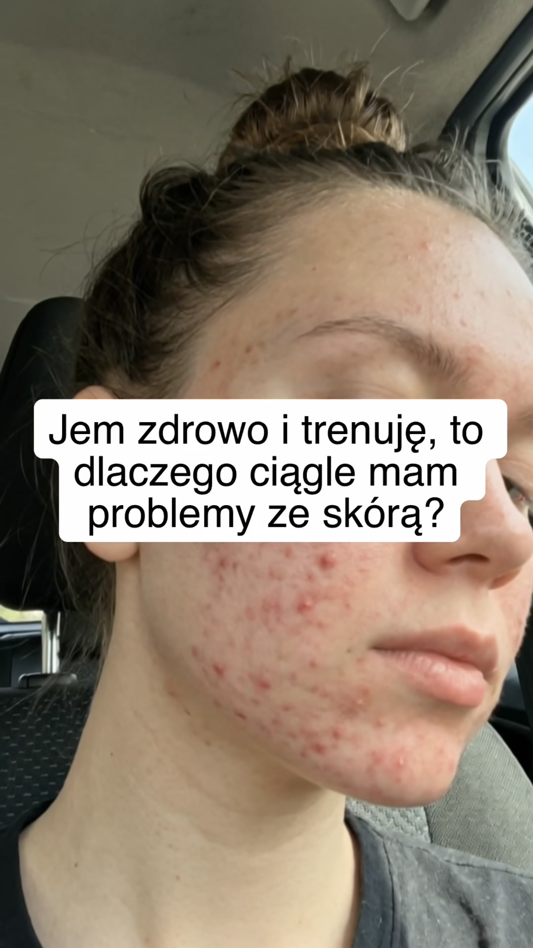 Co w jelitach, to na skórze.