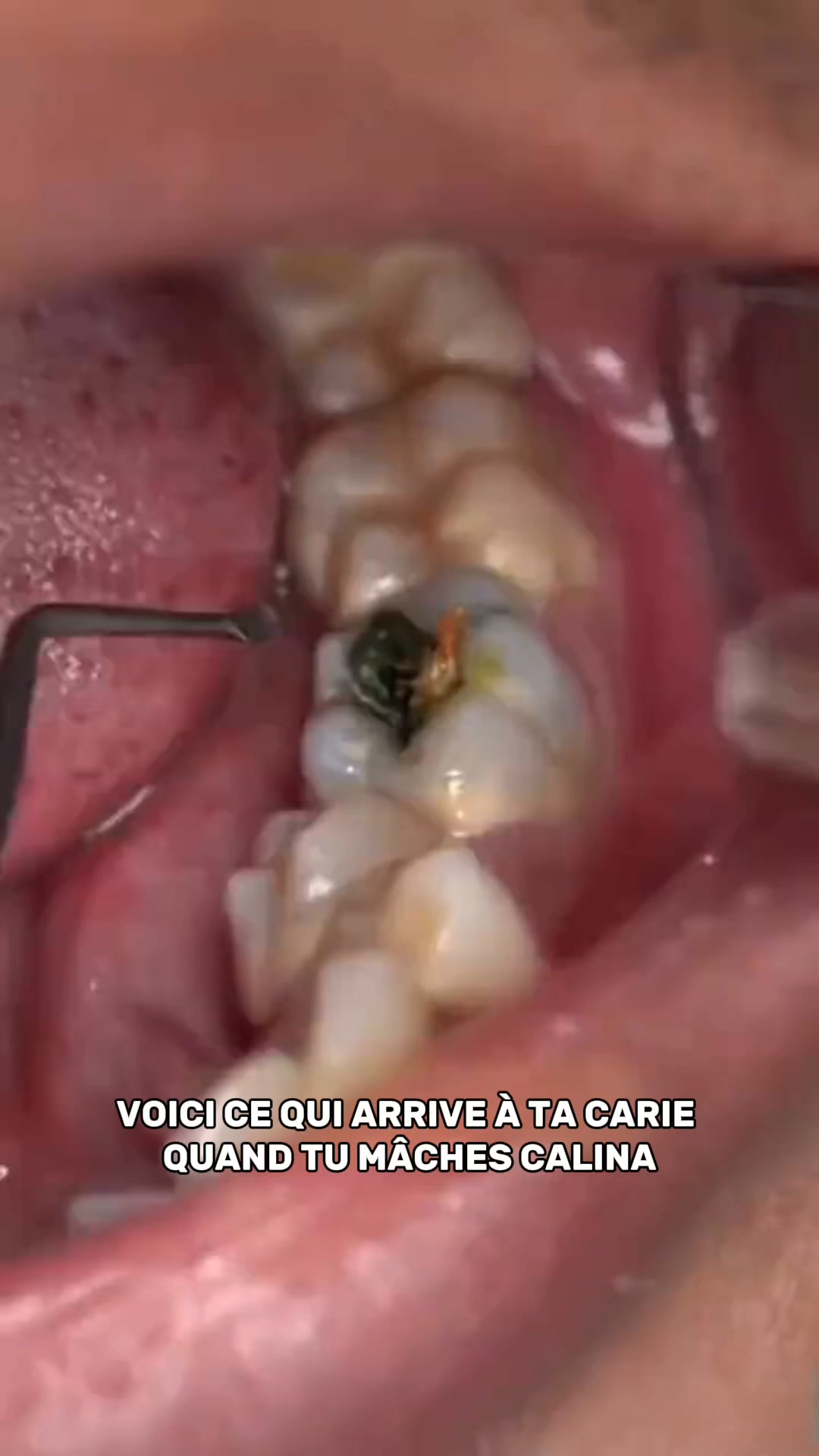 Cette solution simple contre le ronflement se vend comme des petits pains.