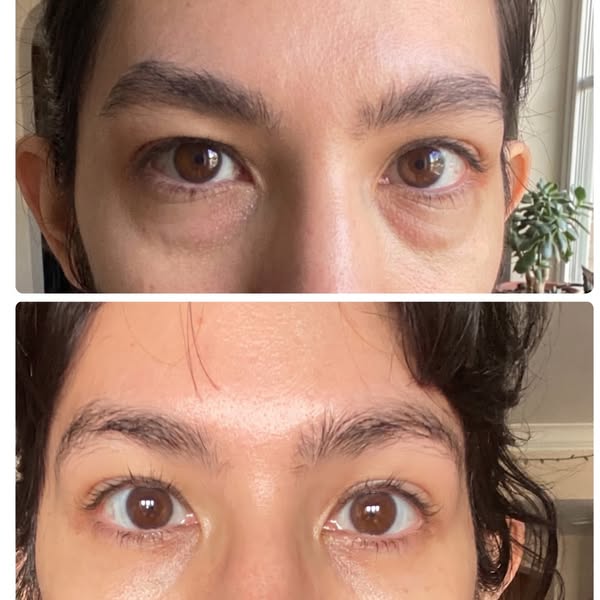 I cancelled my blepharoplasty for $45.