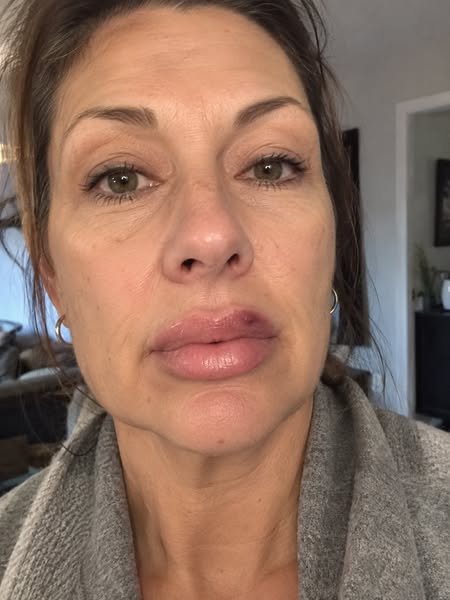 I almost booked lip filler again. Then I found this.