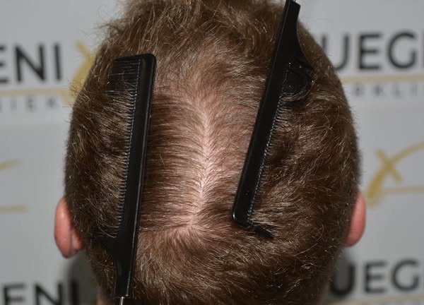 Art Gallery | FueGenix | Hair Restoration Artistry