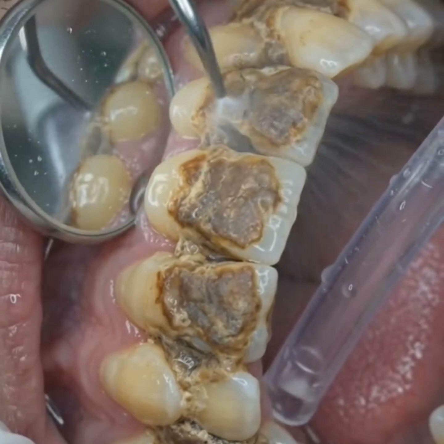 Il trattamento per le gengive di cui si parla in Italia | Disponibile in tutta Italia | Ispirato ai principi della cura parodontale pro
