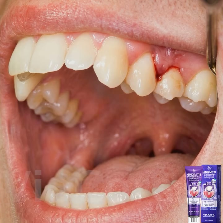 Gum Healing Endorsed by the Academy of Periodontology (AAP) | Full refund guarantee