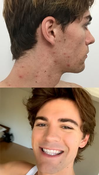 [My Acne Secret]