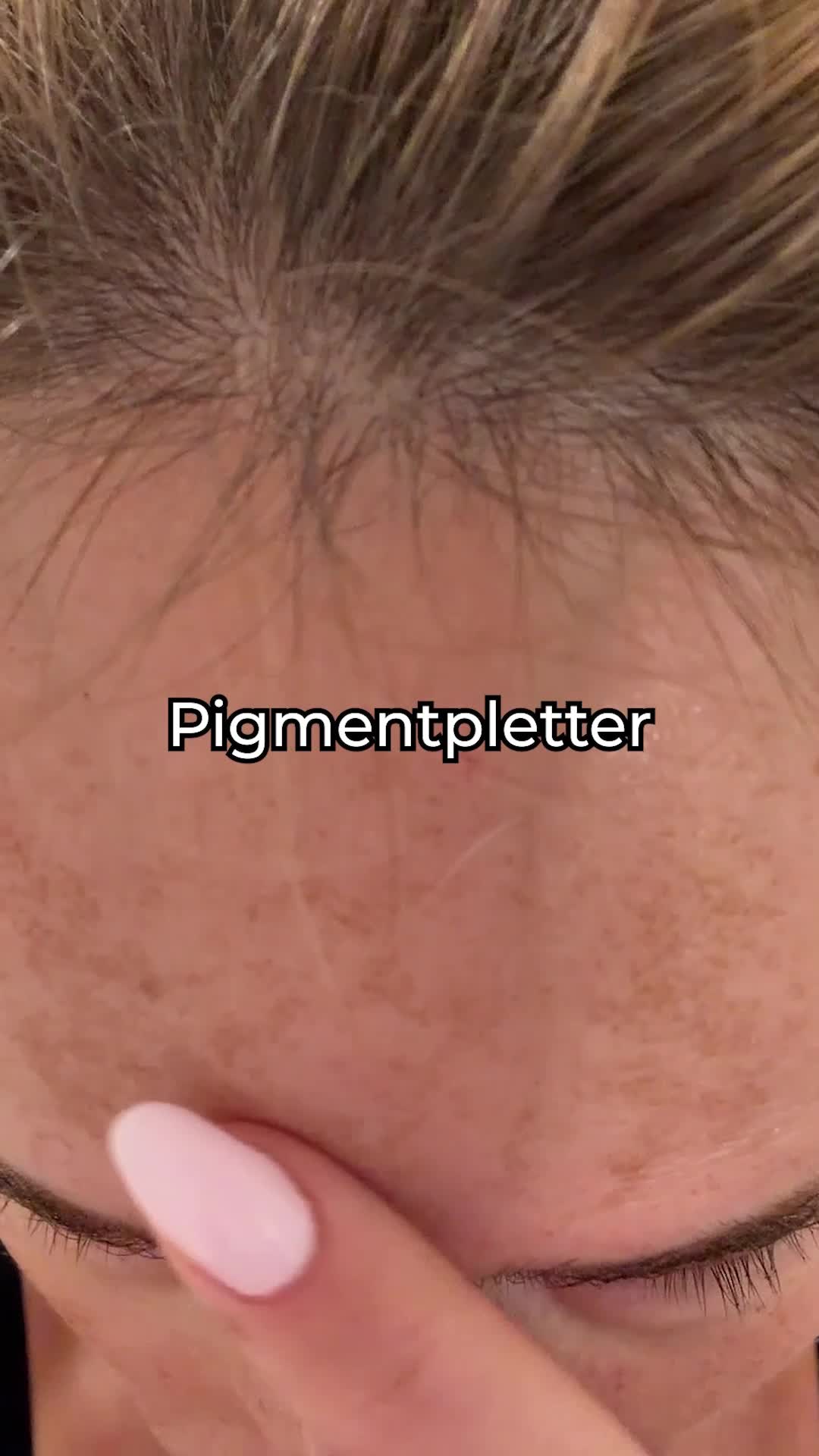 Synligt reducerer pigmentpletter