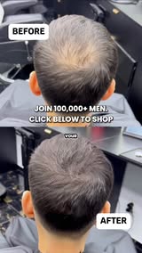 Seeing More Scalp Lately?