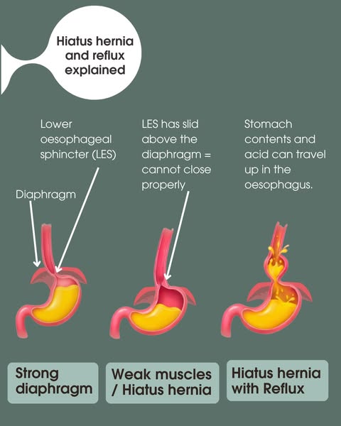 Snoring – Symptoms and treatment to stop snoring
