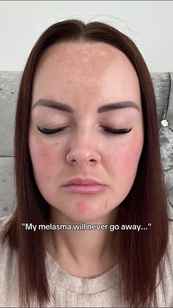 Treat melasma with a retinoids formula