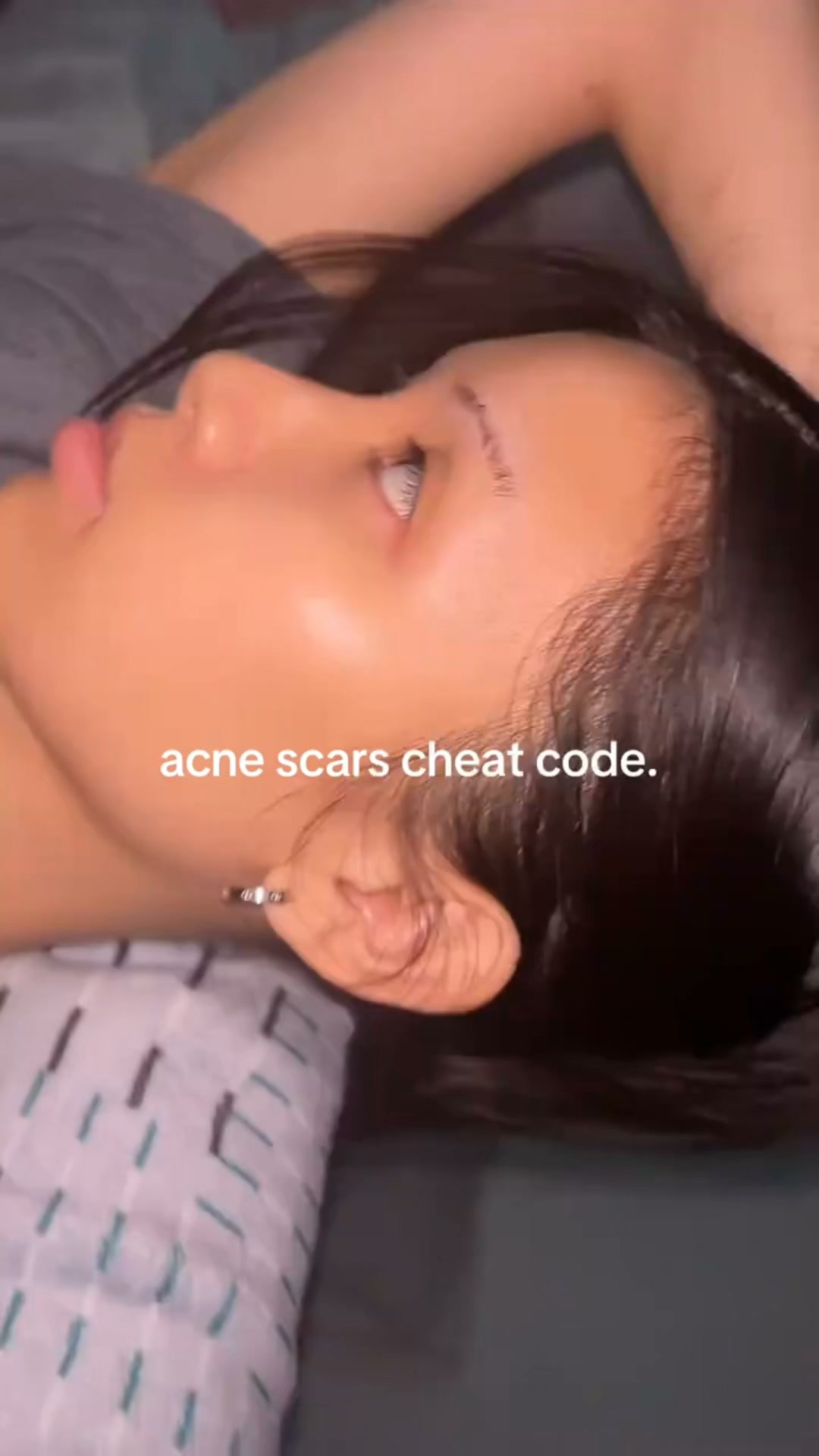 The Korean Answer To Acne’s Aftermath