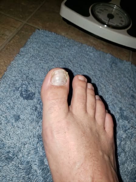 Read this if you have toe fungus
