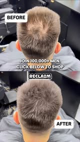 Seeing More Scalp Lately?