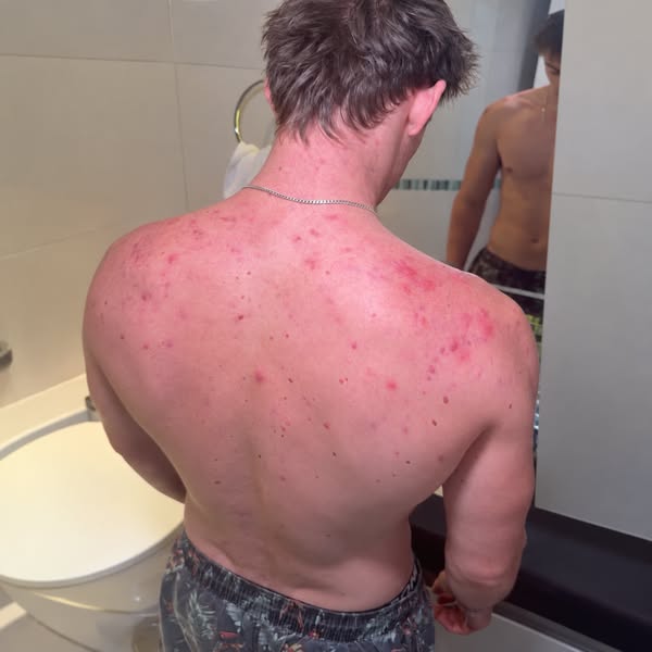 This is a Bacne Scar up close