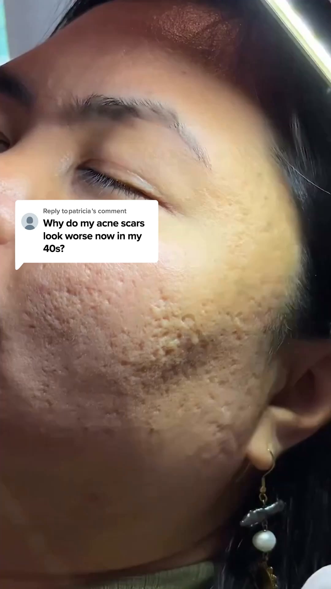 Fading Acne Scars Got Easier