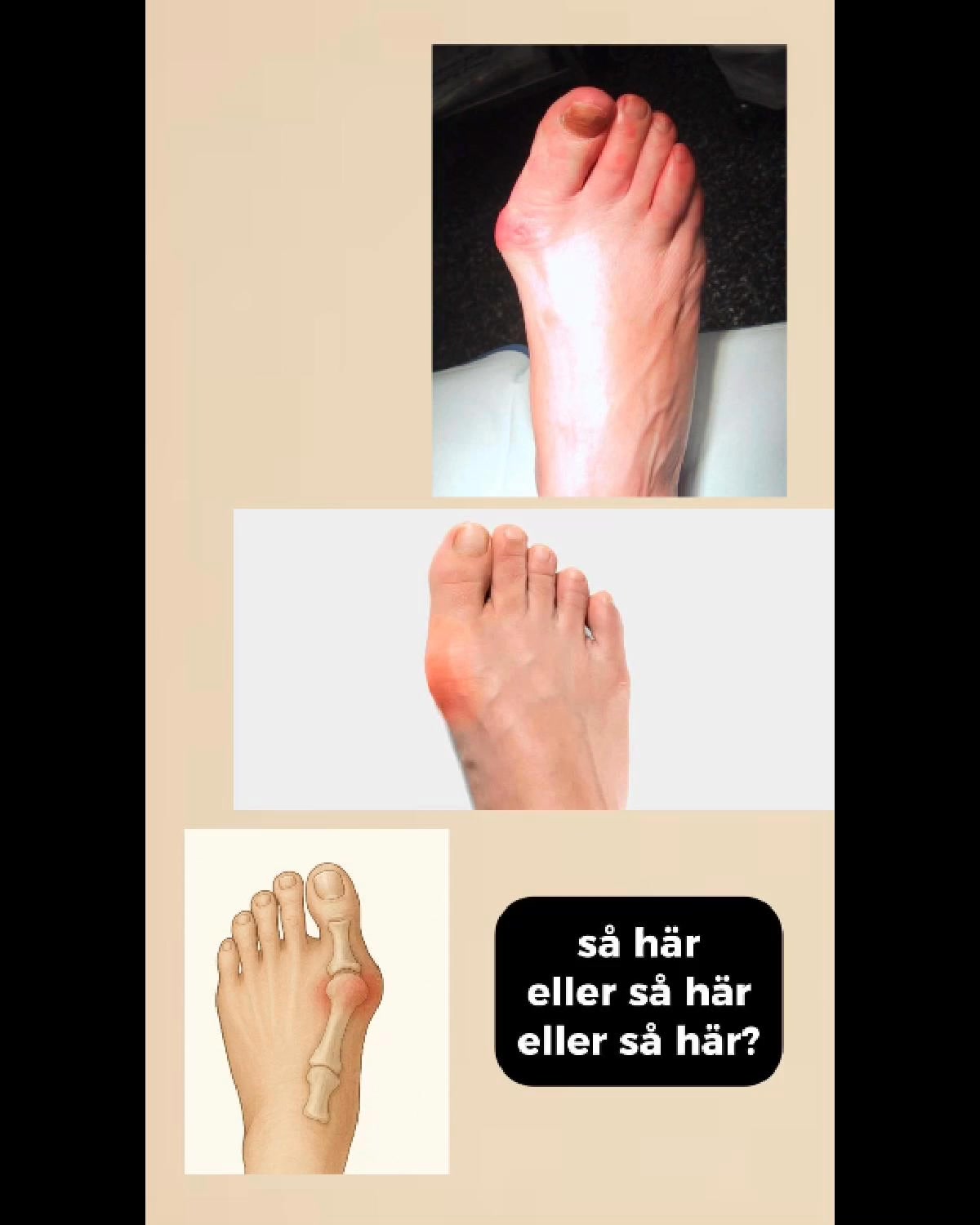 Har du en sned stortå?