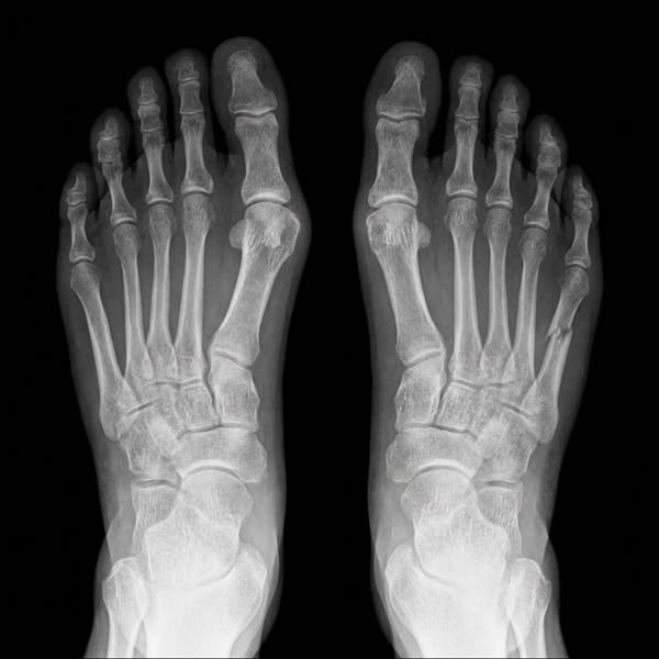 Fix Neuropathy Naturally