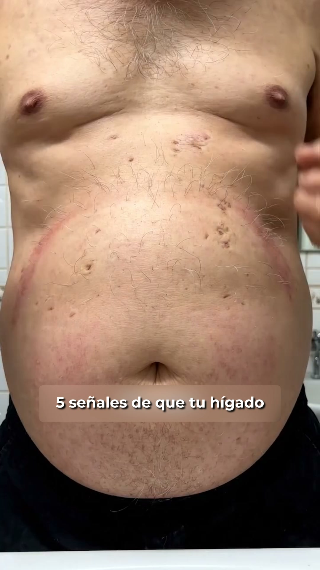 Lo que tus análisis aún no muestran — pero que tus riñones ya sienten