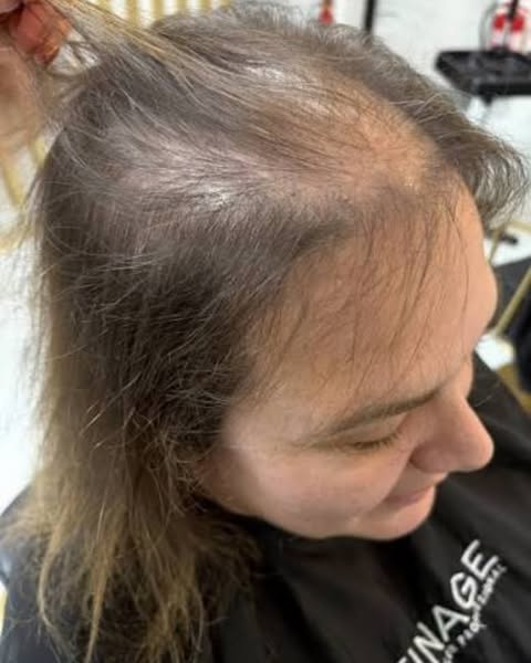 I lost two and a half stone on Mounjaro. Then I lost half my hair.