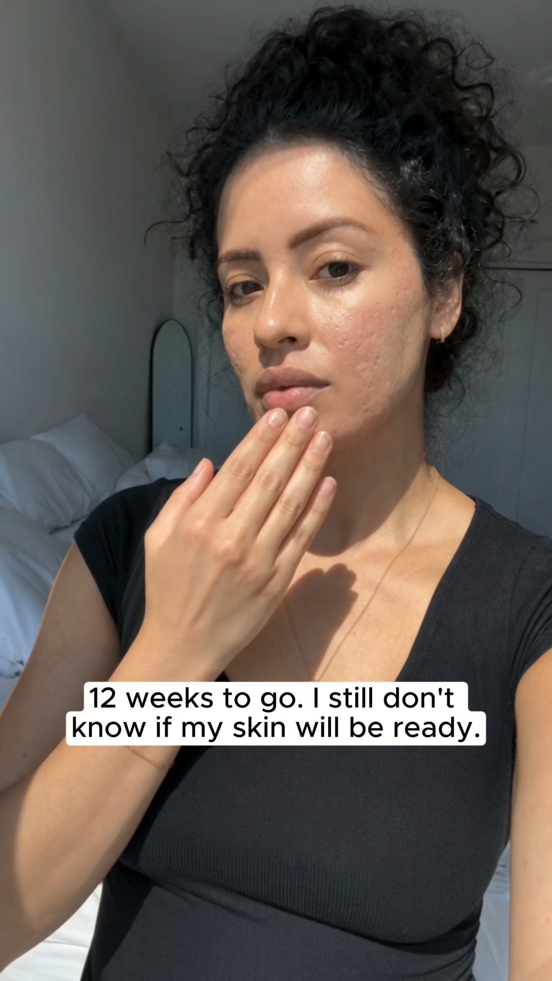 My 12-Week Acne Scar Countdown