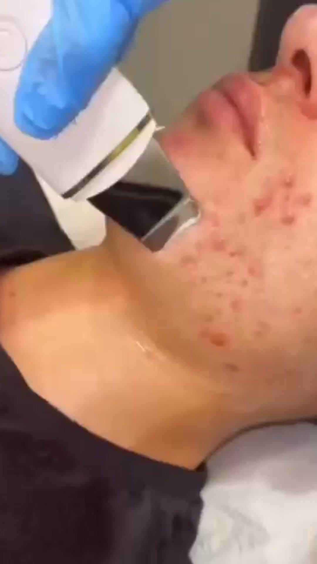 Stop Acne - Bespaar 50%