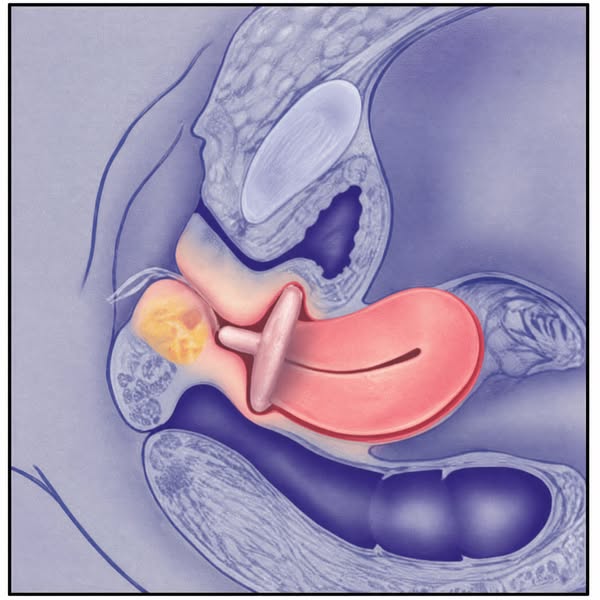 If prolapse repair is already on your calendar, read this