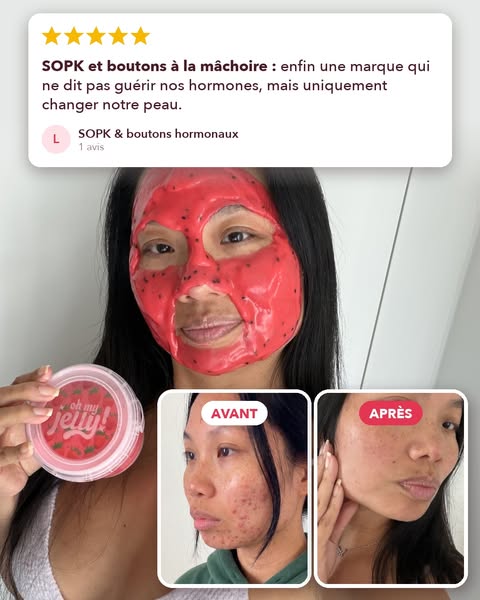 SOPK : 91 % ont vu leurs boutons réduits en 4 semaines. Sans toucher aux hormones.