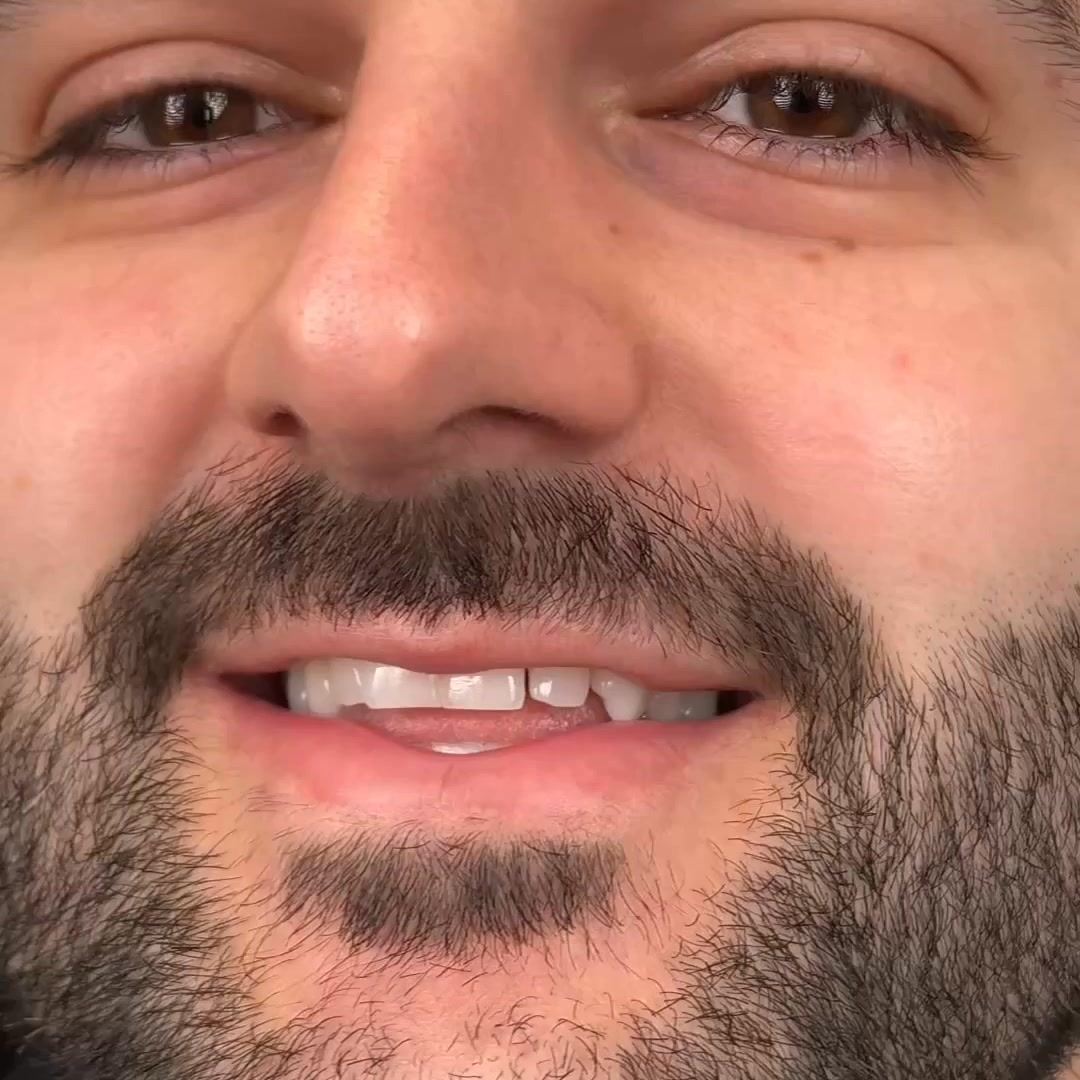 3,400 Patients. Zero Turkey Teeth. Here Is How We Do Composite Bonding Differently.