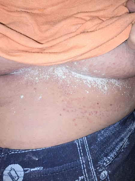 Why your chafing always comes back