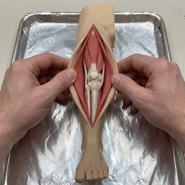 "5 years of oedema swelling gone in 1 month?"