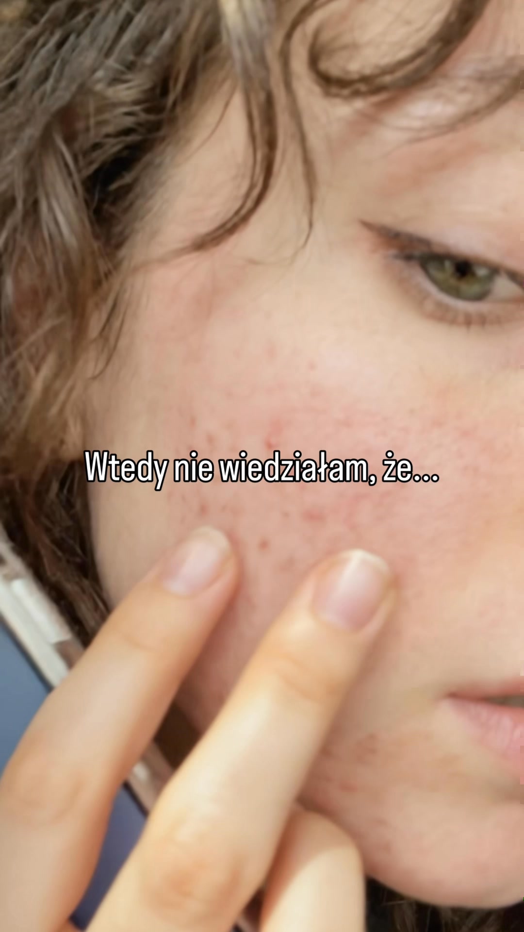 Co w jelitach, to na skórze.