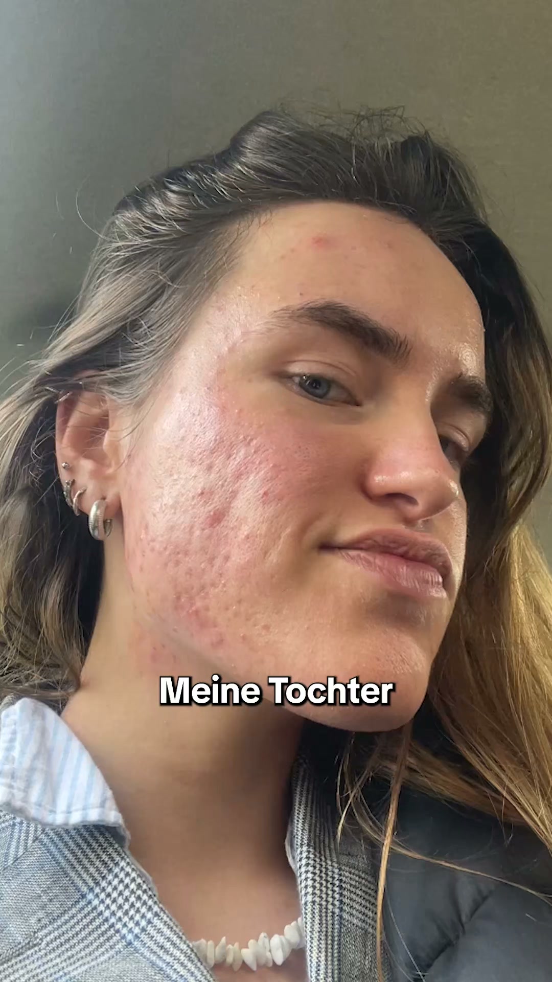 Akne im Erwachsenenalter? Das hilft