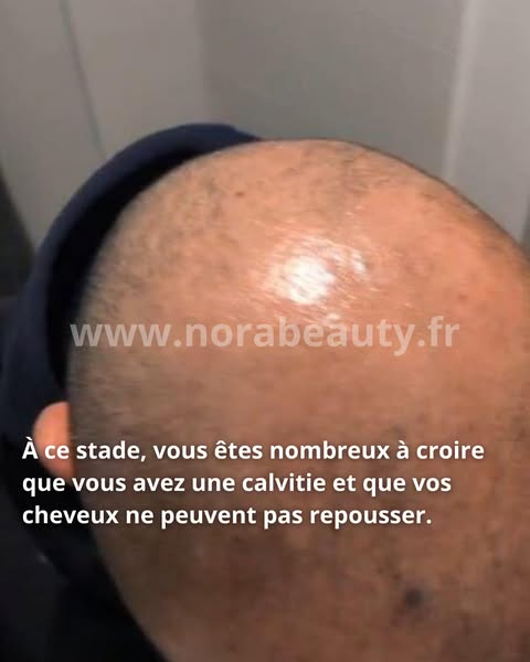 Calvitie : agir avant qu’il ne soit trop tard
