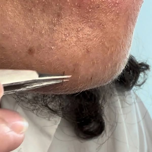 Read this if you want to get rid of chin hair